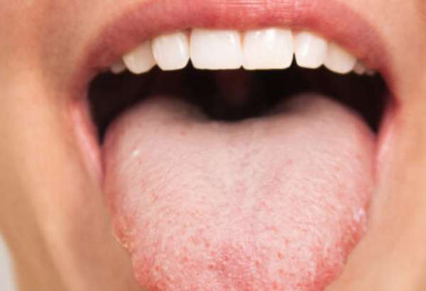 vas jazyk prezradi viac nez si myslite tieto zmeny mozu signalizovat vazne problemy