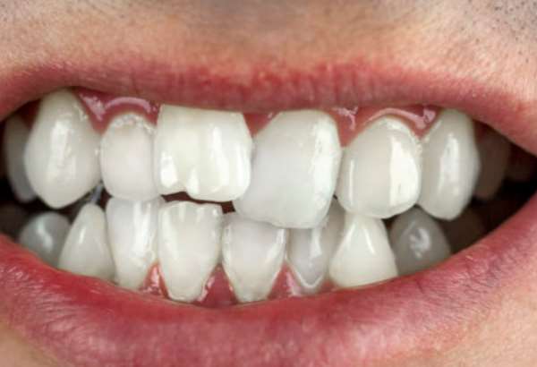 krive zuby nie su len estetickym problemom poistovne preplacaju liecbu strojcekom do 18 rokov