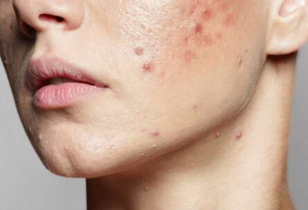 virusy ktore vas zbavia akne nova liecba je hitom medzi dermatologmi